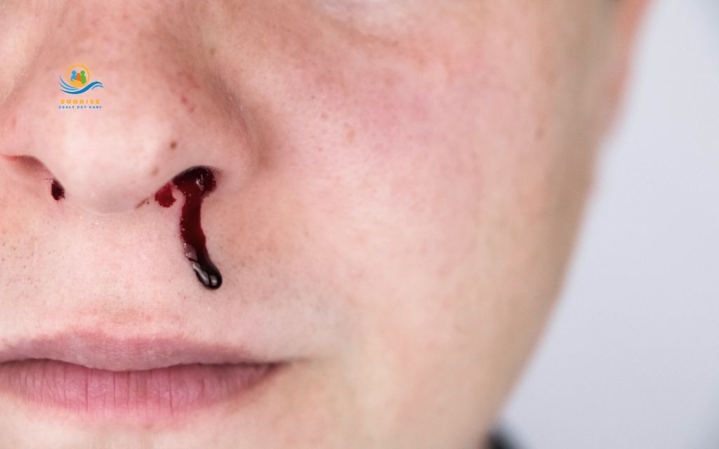 Common causes of nosebleeds in elderly people