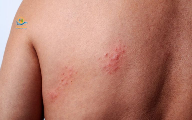 Shingles in old people: Why it’s more serious after 60